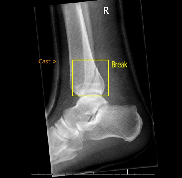 Sprained Ankle X-ray
